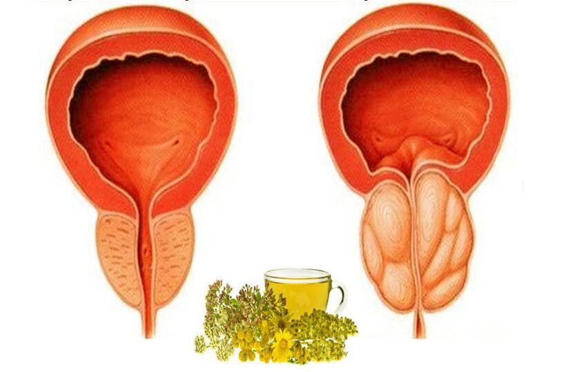 Prostate saine et douloureuse